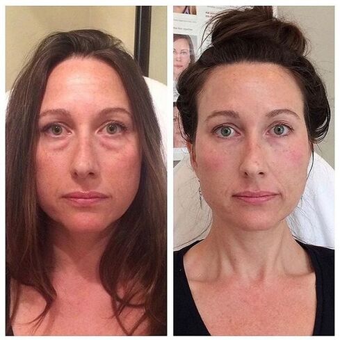 Chica antes y después del rejuvenecimiento facial con láser