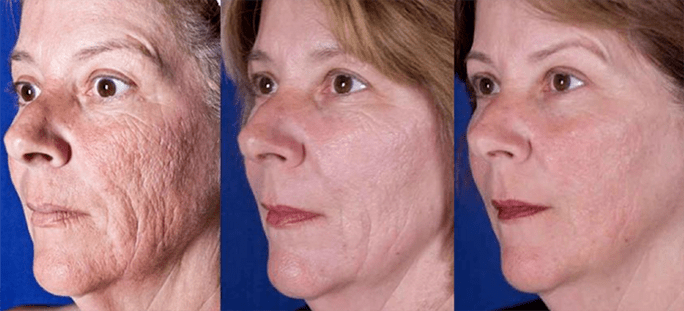 Resultado después del procedimiento de rejuvenecimiento de la piel facial con láser