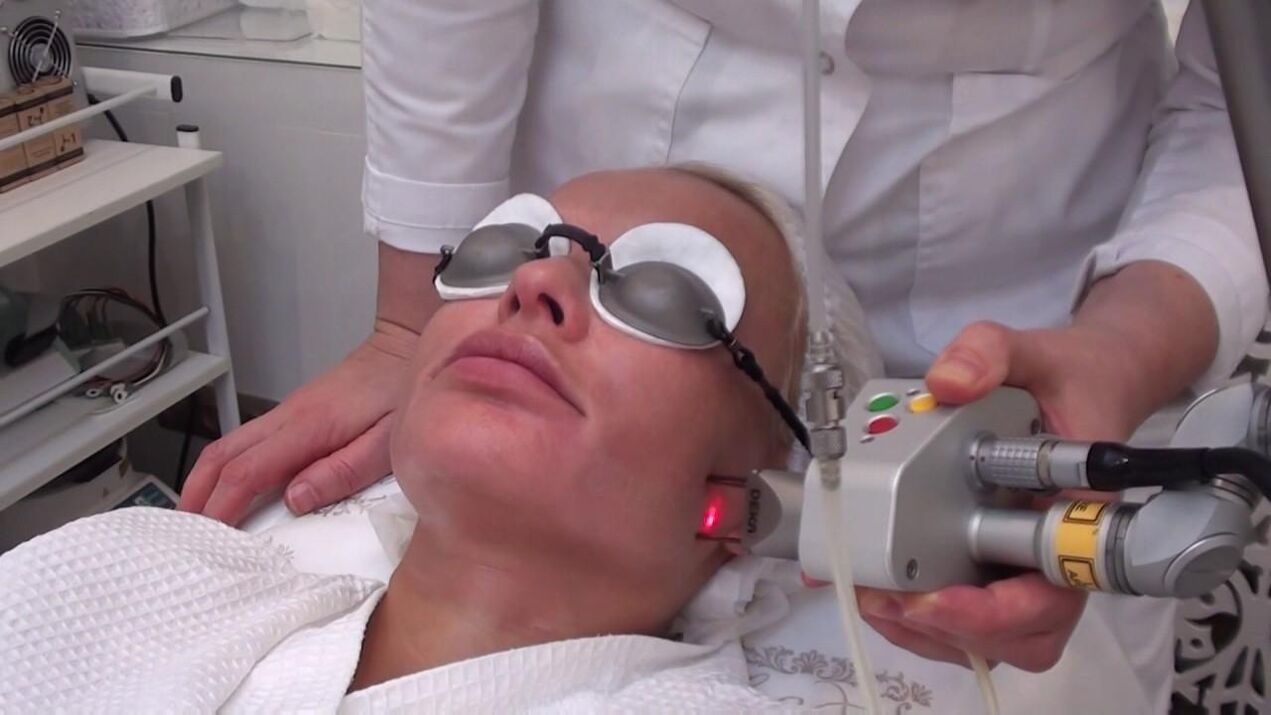 Tratamiento con un rayo láser de áreas problemáticas de la piel de la cara. 